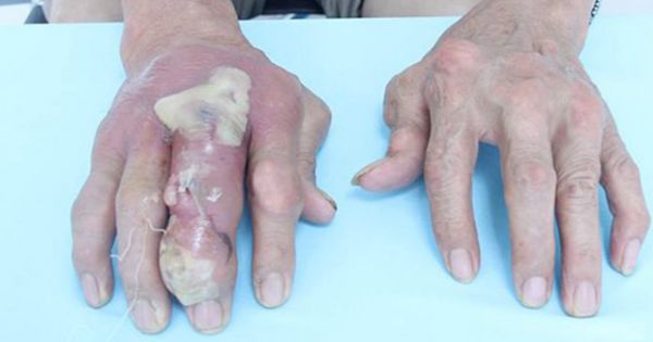Hình ảnh vỡ loét, nhiễm trùng và biến dạng khớp do hạt tophi