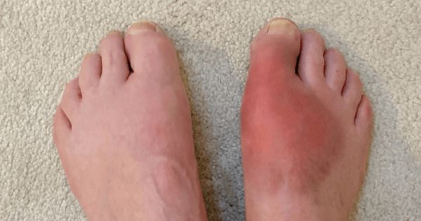 Hình ảnh bàn chân bị sưng đỏ phần khớp do gout