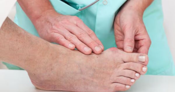 Người bệnh Gout nên đi khám khi có cơn đau cấp hoặc tái phát