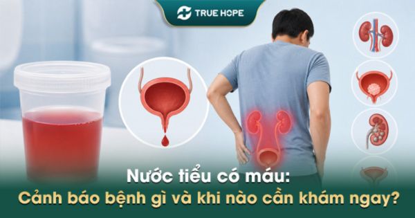 Nước tiểu có máu ở nam