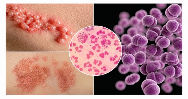 Hình ảnh tiểu rắt do ảnh hưởng của bệnh liên quan đến tình dục