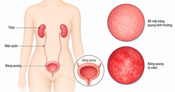 Hình ảnh mô phỏng viêm bàng quang gây tiểu rắt