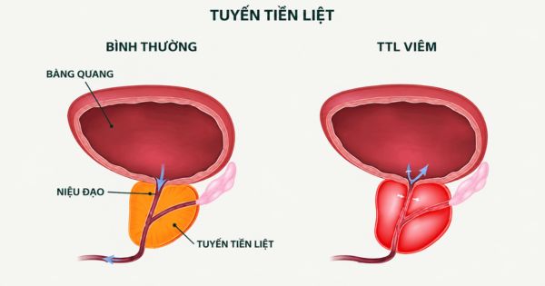 Hình ảnh mô phỏng tiểu rắt do viêm tuyến tiền liệt ở nam giới