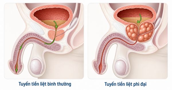 Phì đại tuyến tiền liệt gây tiểu rắt tiểu đêm ở nam giới