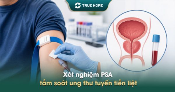 Xét nghiệm PSA tầm soát ung thư tuyến tiền liệt