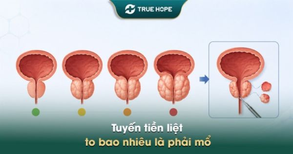 Tuyến tiền liệt to bao nhiêu là phải mổ