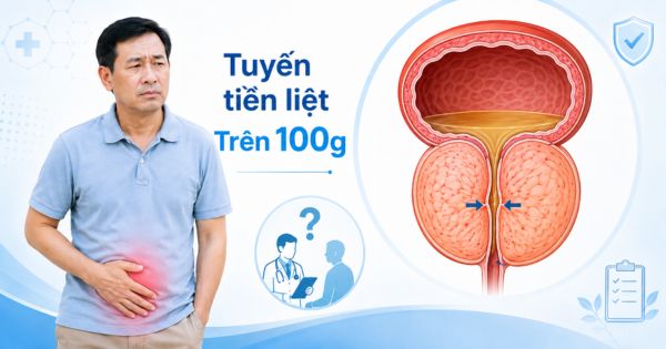 Cần can thiệp ngoại khoa khi tuyến tiền liệt khoảng 100g gây ảnh hưởng sinh hoạt