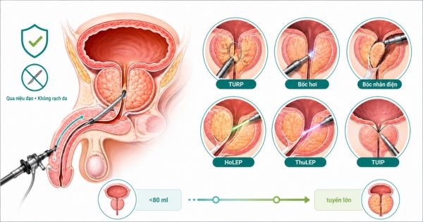 Các phương pháp mổ nội soi tuyến tiền liệt