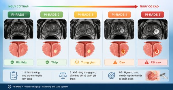 Các mức điểm PI-RADS trong bệnh lý tuyến tiền liệt