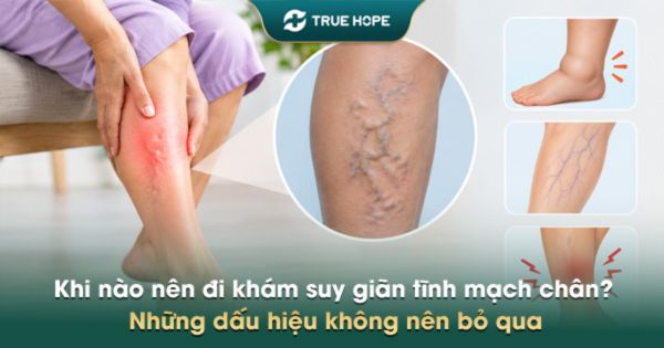 Khi nào nên đi khám suy giãn tĩnh mạch chân? Những dấu hiệu không nên bỏ qua