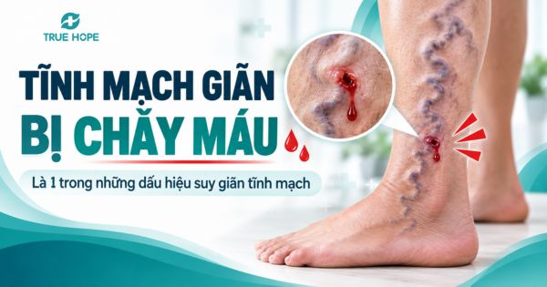 Tĩnh mạch giãn bị chảy máu là 1 trong những dấu hiệu suy giãn tĩnh mạch