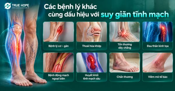 Các bệnh lý khác cùng dấu hiệu với suy giãn tĩnh mạch