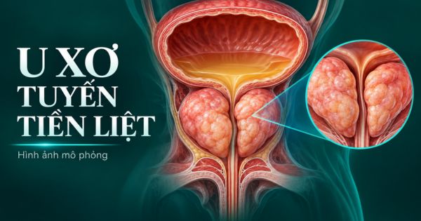 Hình ảnh mô phỏng u xơ tiền liệt tuyến