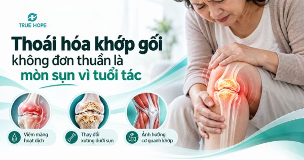 Thoái hóa khớp gối không đơn thuần là mòn sụn vì tuổi tác