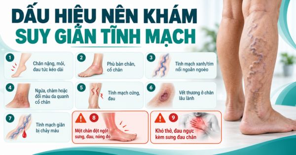 Dấu hiệu nên khám suy giãn tĩnh mạch