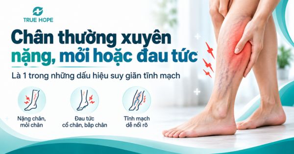 Chân thường xuyên nặng, mỏi hoặc đau tức là 1 trong những dấu hiệu suy giãn tĩnh mạch