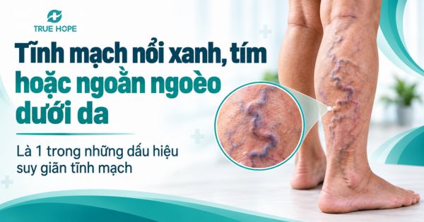 Tĩnh mạch nổi xanh, tím hoặc ngoằn ngoèo dưới da là 1 trong những dấu hiệu suy giãn tĩnh mạch