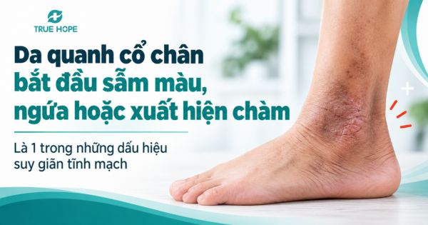 Da quanh cổ chân bắt đầu sẫm màu, ngứa hoặc xuất hiện chàm là 1 trong những dấu hiệu suy giãn tĩnh mạch