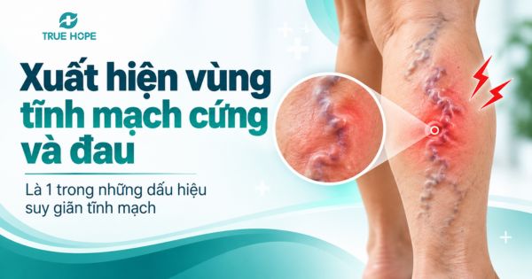Xuất hiện vùng tĩnh mạch cứng và đau là 1 trong những dấu hiệu suy giãn tĩnh mạch