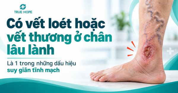 Có vết loét hoặc vết thương ở chân lâu lành là 1 trong những dấu hiệu suy giãn tĩnh mạch